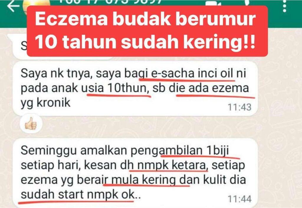 TESTIMONI BUDAK 10 TAHUN ECZEMA SUDAH KERING